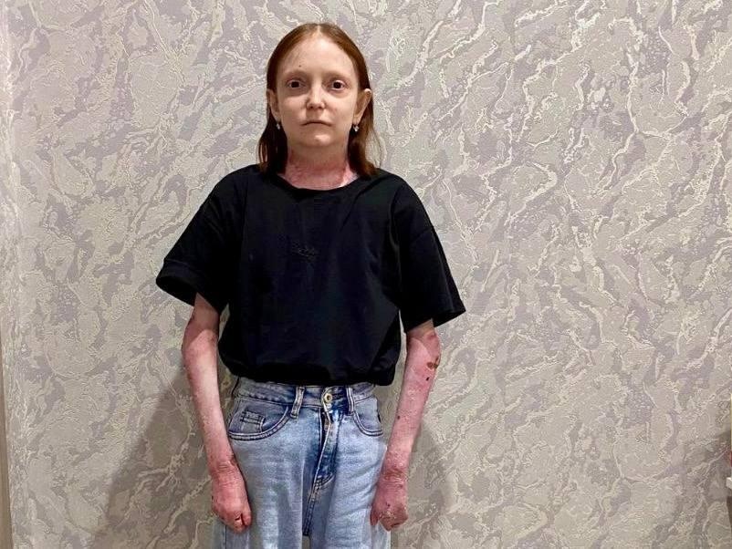 Девушке с тяжелым генетическим заболеванием кожи требуется очередное обследование онколога