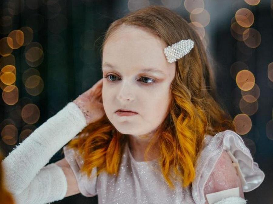 У Даши генетическое заболевание. Ей нужны повязки, которые защищают ее кожу от ран и инфекций