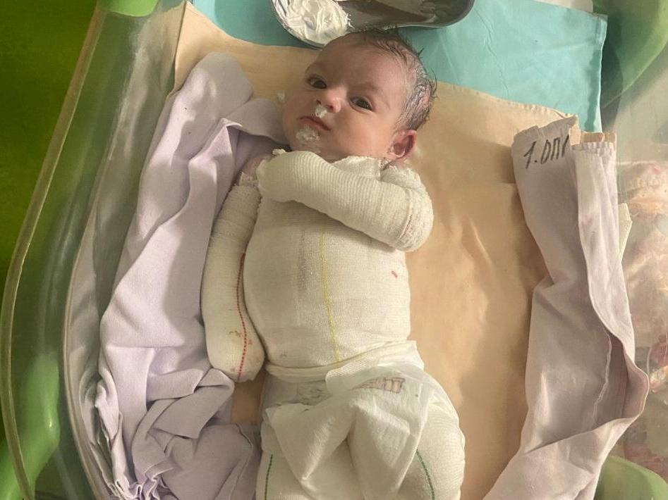 Нубар и еще одной девочке с генетическим заболеванием нужны атравматические повязки для защиты кожи!