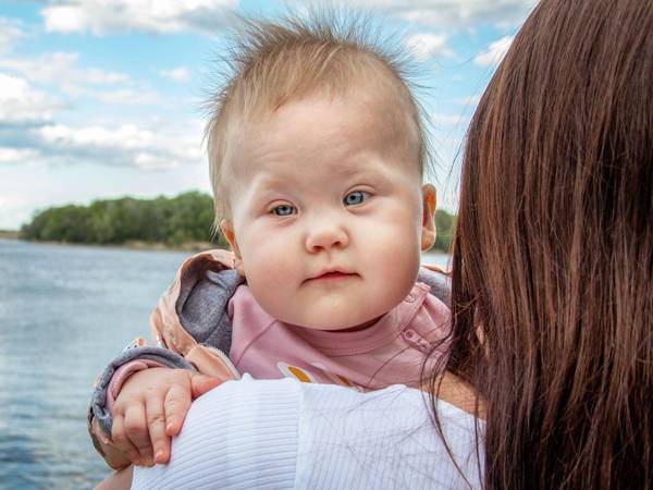 У Маши врожденнaя деформация черепа: ей нужна операция