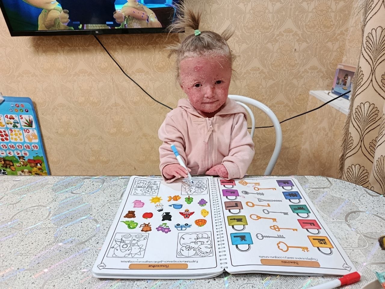 Ульяне с редким заболеванием необходимы средства для кожи
