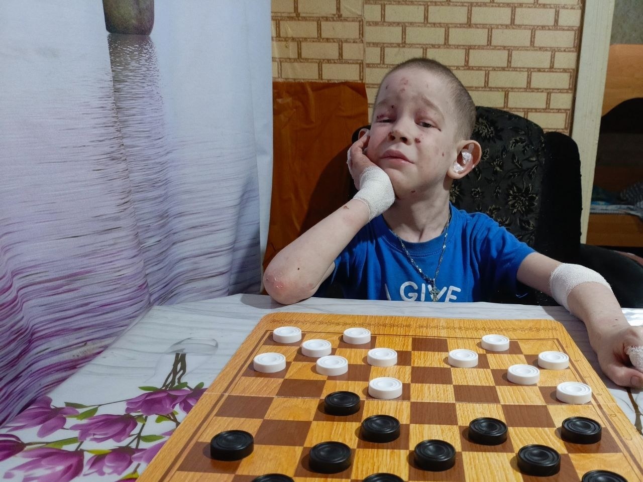 У Толи генетическое заболевание. Ему нужны специальные бинты и кремы для защиты кожи
