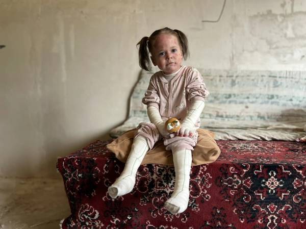 Special nutrition for Rukiyat is an important step in supporting patients with bullous epidermolysis.
