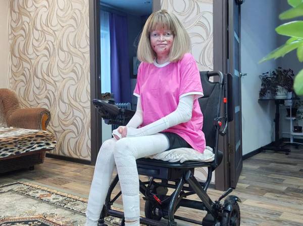 Special dressings for Dasha, who has a severe form of epidermolysis bullosa.