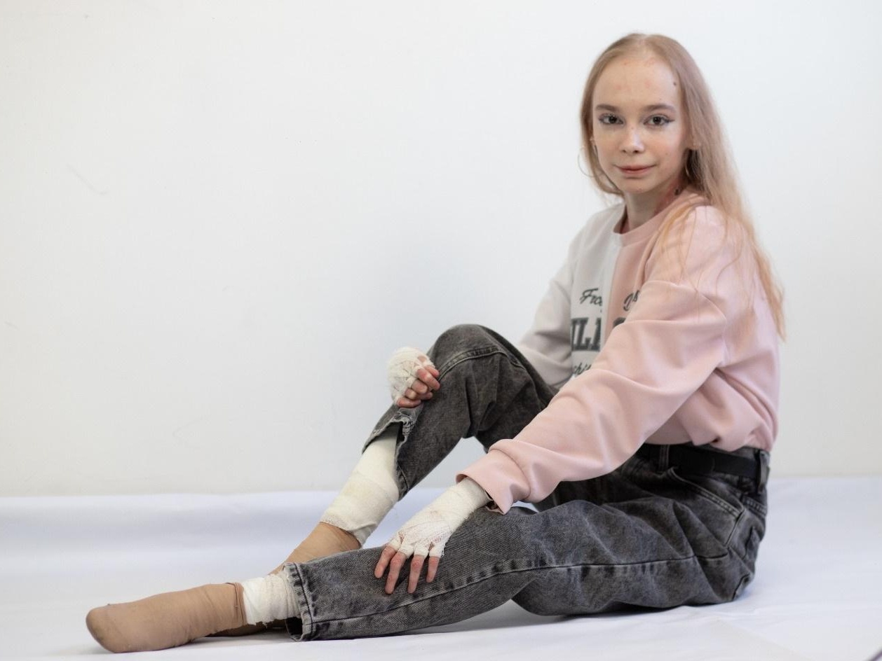 У Линнеты генетическое заболевание кожи, ей нужны специальные мази и бинты!