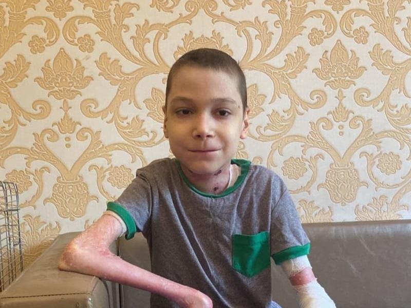 У Магомеда генетическое заболевание кожи. Ему нужны моделируемые повязки для её защиты!