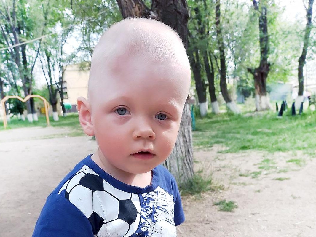 Ilya's skull bones are prematurely fused. An operation is needed so that the child's brain can grow and develop
