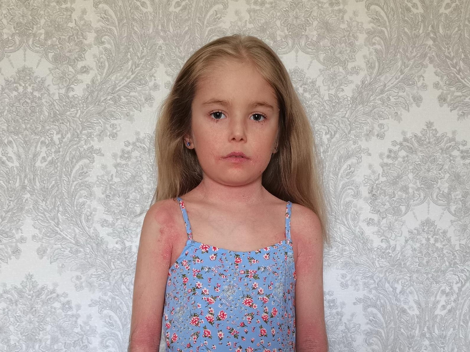 Даше нужны специальные уходовые средства, чтобы легче переносить последствия кожного заболевания!