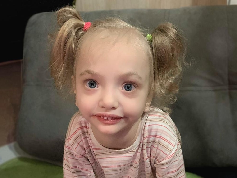 Varya has Williams syndrome. The baby needs rehabilitation to overcome developmental delays