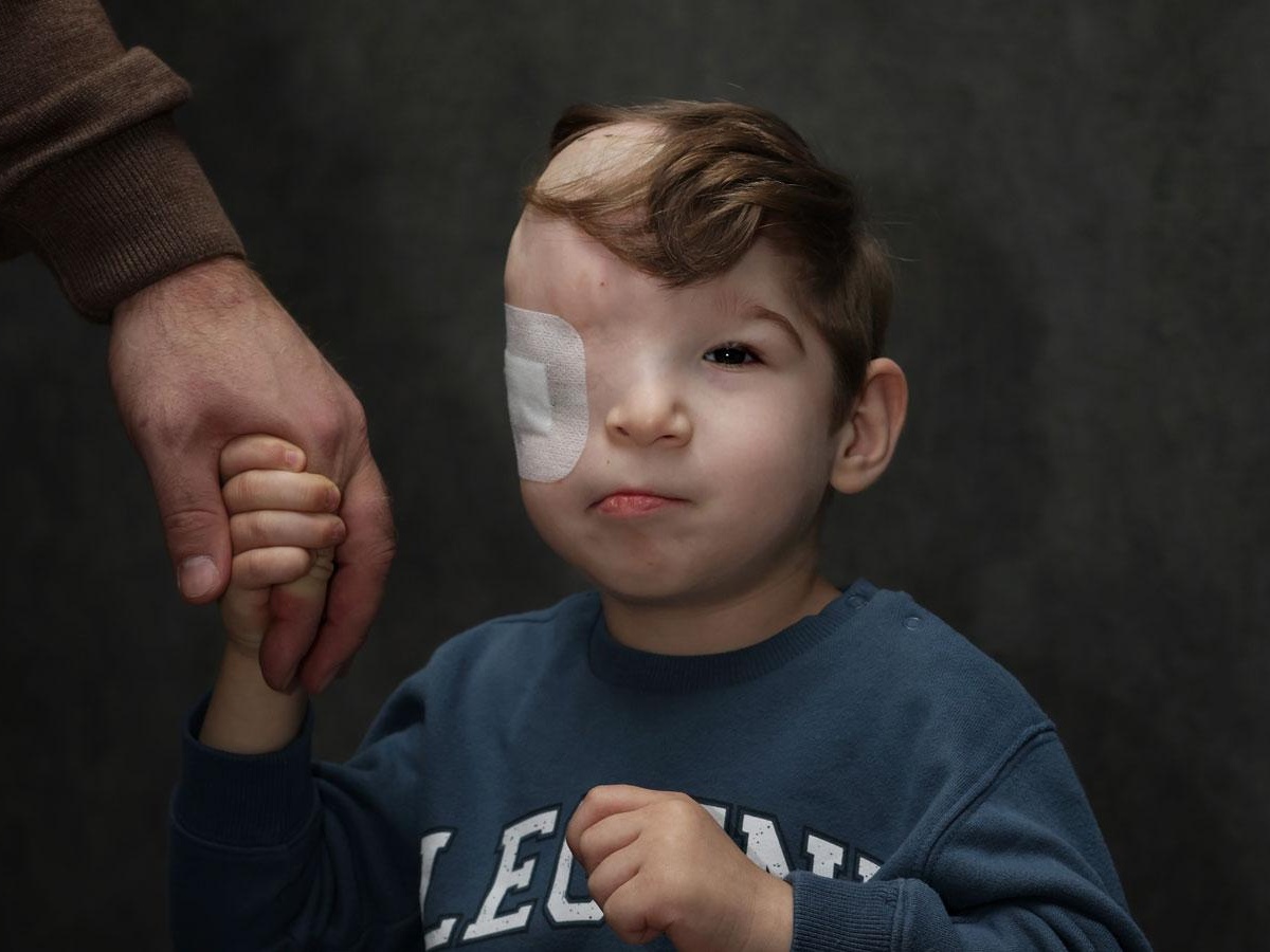 Ayub needs titanium plates to correct his head deformity