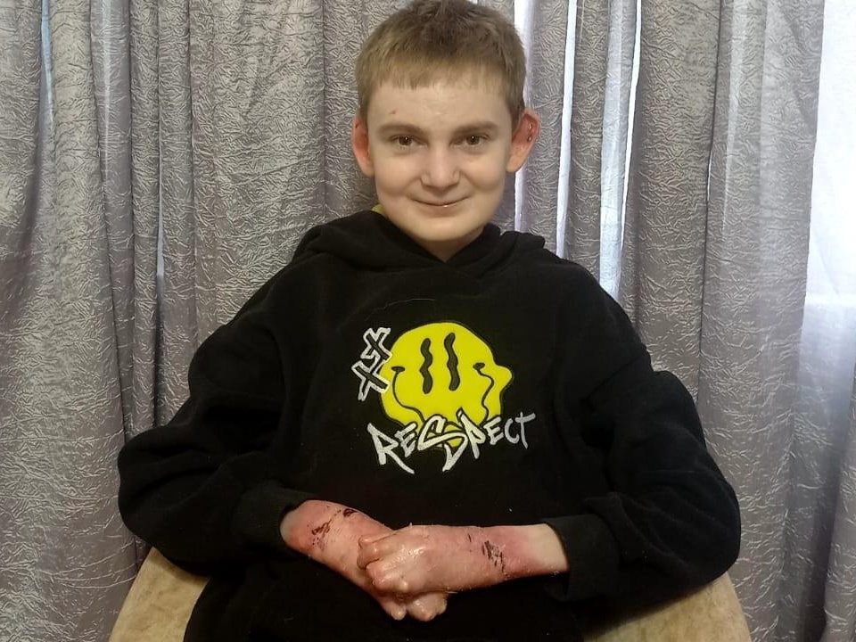 Mikhail and another child with a genetic disease need to come for a dressing after the operation to separate the fingers!