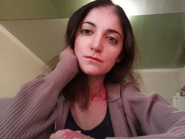 Раксане необходимо приехать на обследование перед операцией по разделению пальцев на руке!
