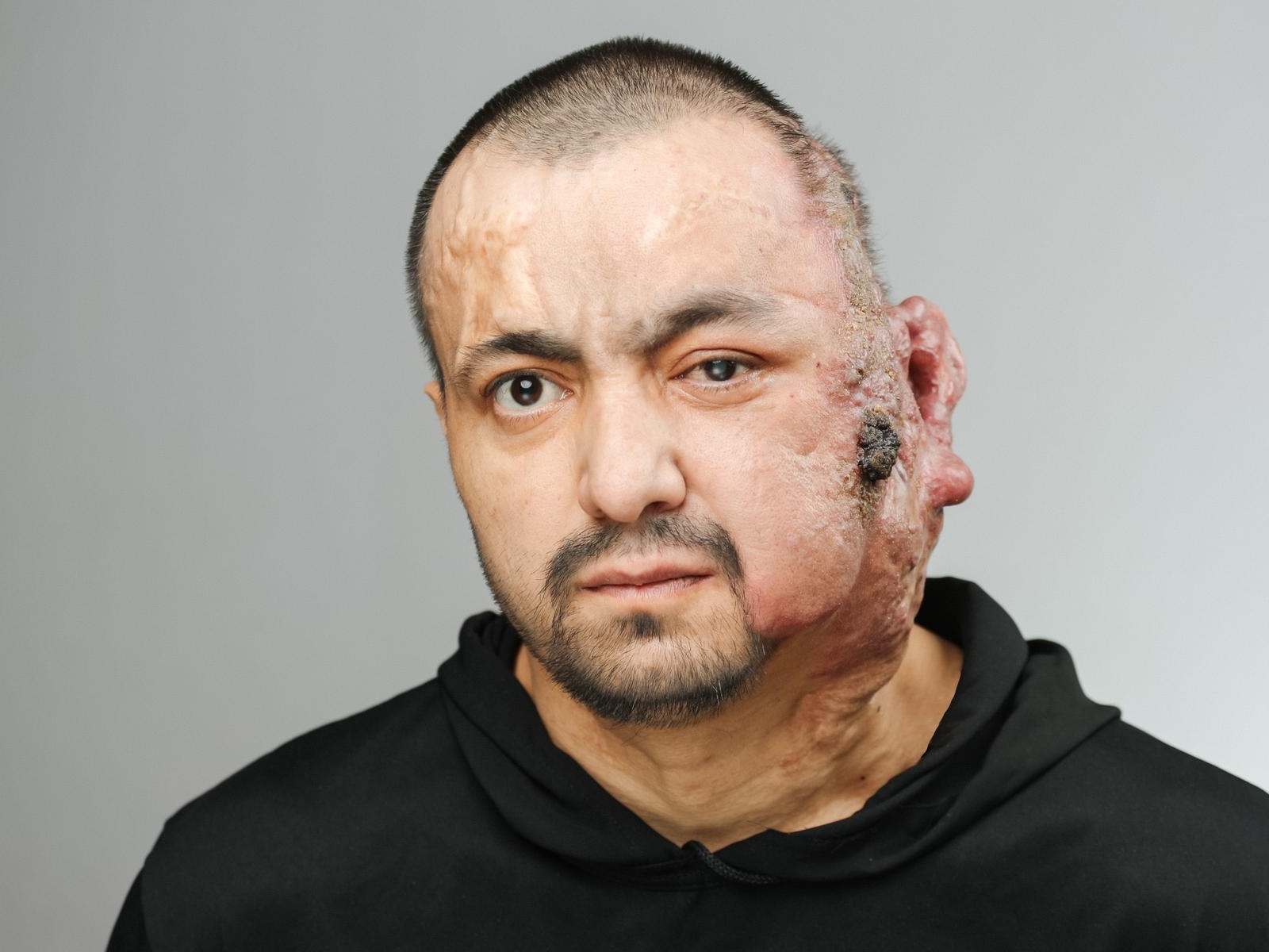 Safarali needs emergency head vascular surgery to save his life!
