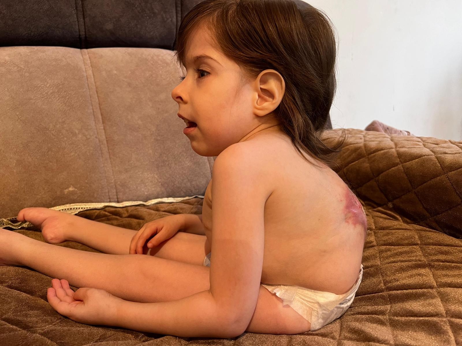 Khadija has a spinal malformation. She needs surgery!