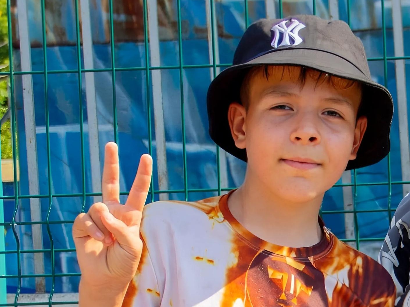 Anton has shunt-related hydrocephalus and epilepsy. He really needs a shunt replacement.