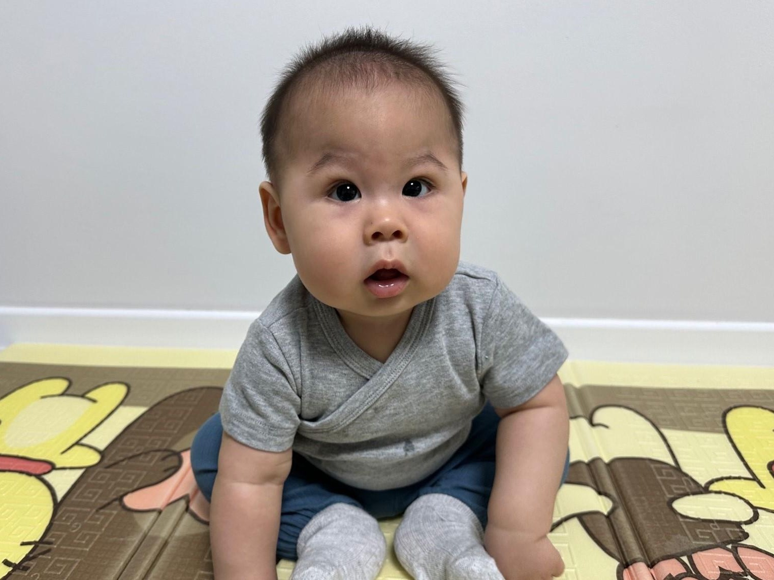 Alen needs skull surgery to grow up healthy