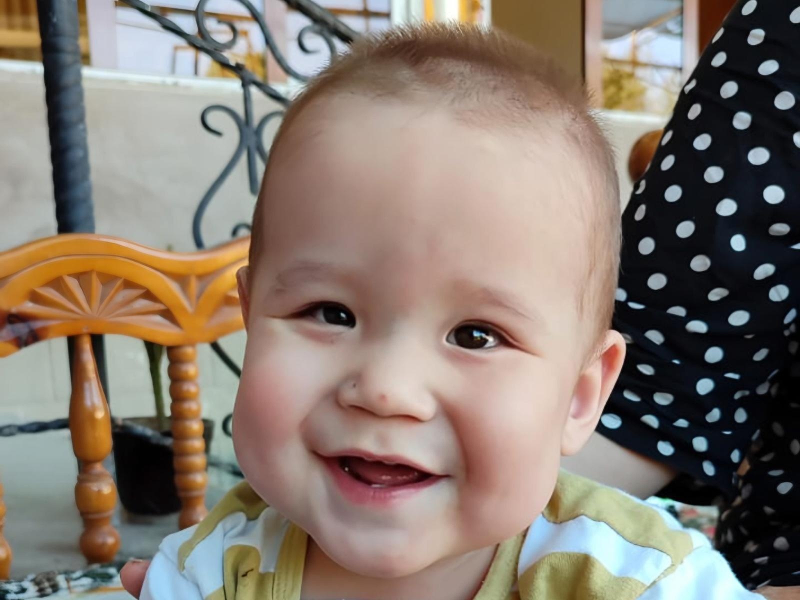 One-year-old Arman has grade 5 retinopathy, he needs surgery!