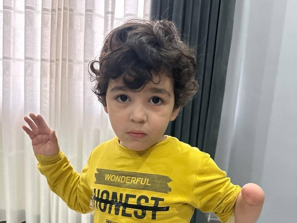 Umar needs a prosthetic left arm