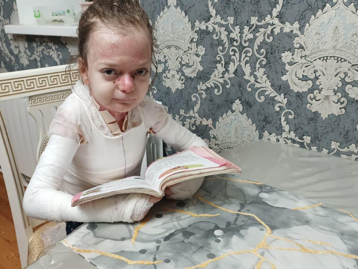 Patimat has a severe dystrophic form of epidermolysis bullosa. She needs special food!